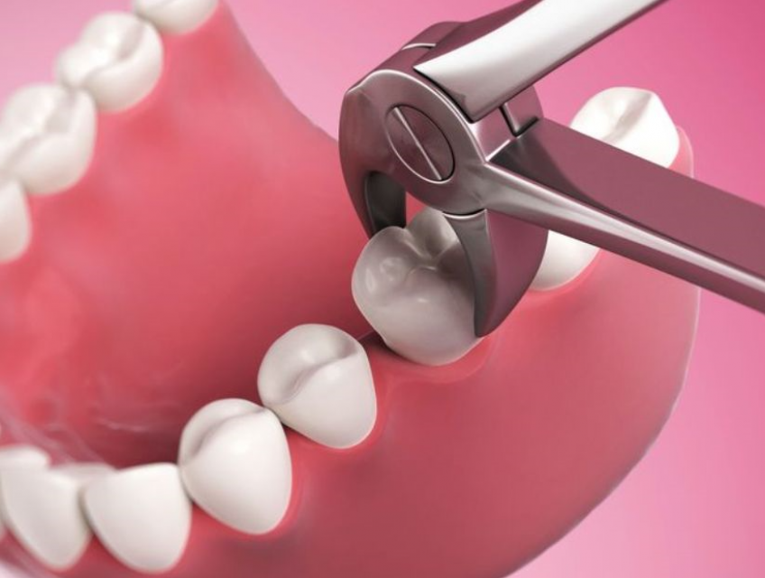 [Giải đáp] Liệu niềng răng có nhổ răng không?