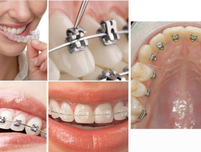 Niềng răng là gì? Có nên niềng răng không?