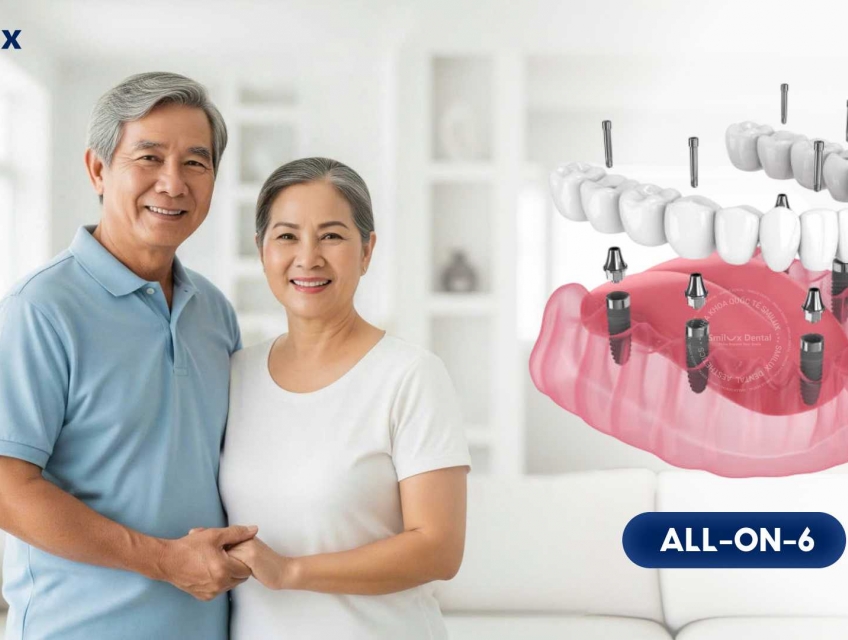 Chọn Smilux trồng Implant toàn hàm được gì?