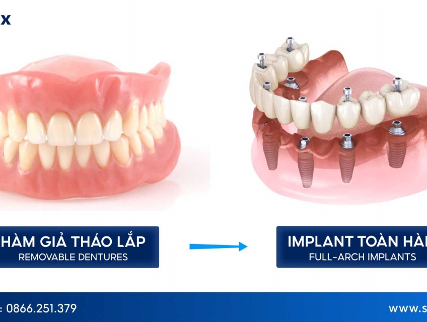 So sánh Implant toàn hàm và hàm giả tháo lắp