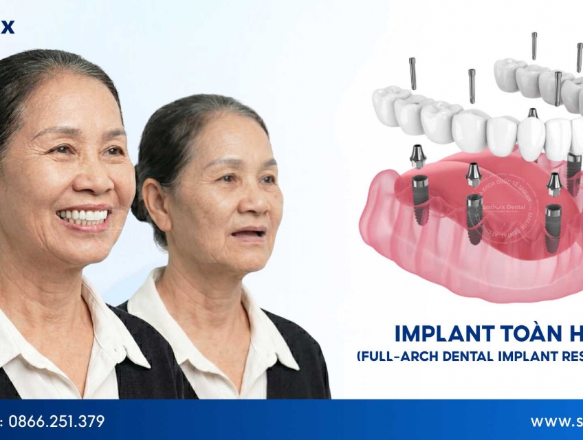 Trồng răng Implant toàn hàm phù hợp với ai trong thực tế?