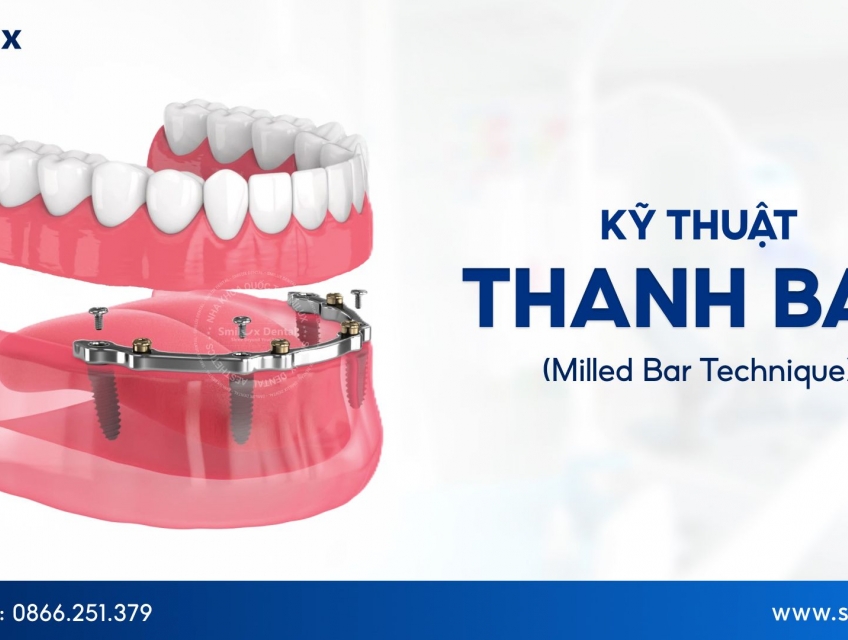 Tìm hiểu kỹ thuật Thanh Bar trong phục hình răng Implant toàn hàm