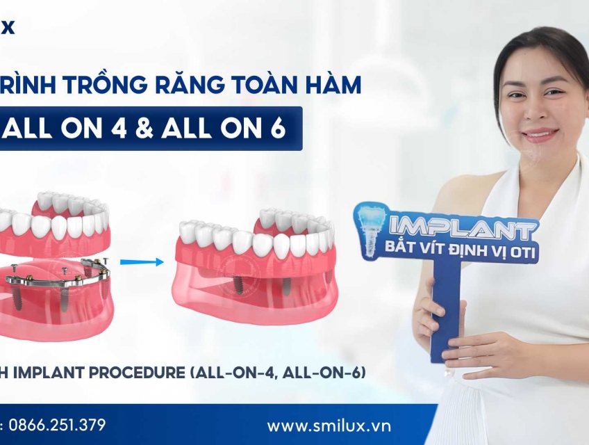 Từ Thăm Khám Đến Phục Hình: Quy Trình Implant Toàn Hàm