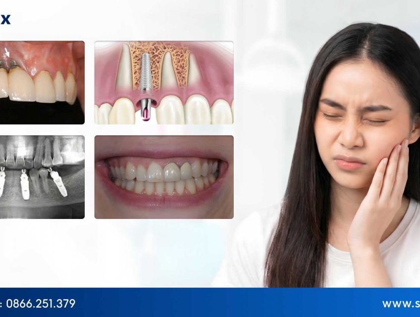 Trồng Implant toàn hàm có an toàn không? Những rủi ro cần lưu ý