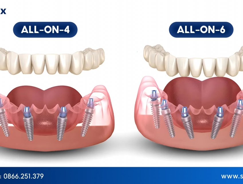All on 4 hay All on 6: Lựa chọn nào tối ưu lâu dài
